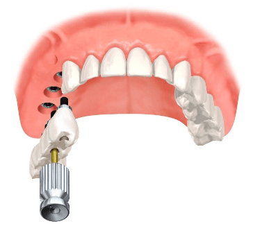 Chirurgie dentaire avec bridge transvissé Tourcoing - Roubaix - Bondues - Croix